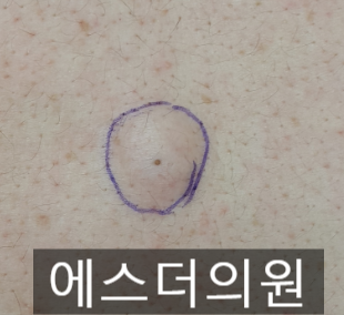 수원 피지낭종 에스더의원 등 표피낭종 제거 [수원표피낭종제거수술핀홀법/화서동고등동피부과/권선구팔달구영통광교용인안양의왕군포화성동탄 ...