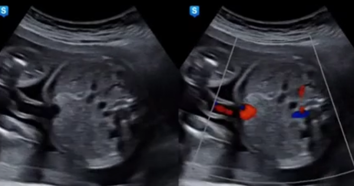 Persistant RT umbilical vein : PRUV : 네이버 블로그