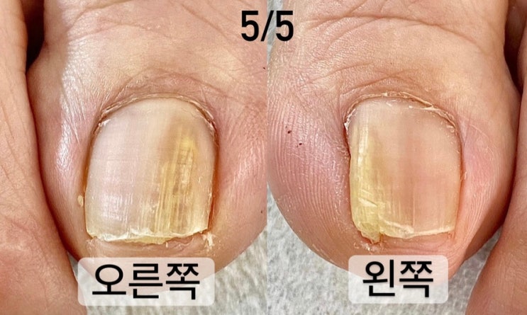 발톱 백선 증상 분명했지만 병원은 '균 없음'? 민락2지구 무좀케어 – 문제성 발톱 은영 부원장 : 네이버 블로그