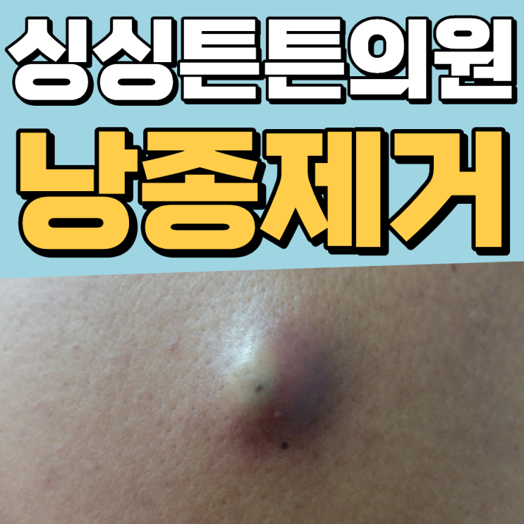 [대전 낭종 제거] 피지낭종, 표피낭종 말끔하게 : 네이버 블로그