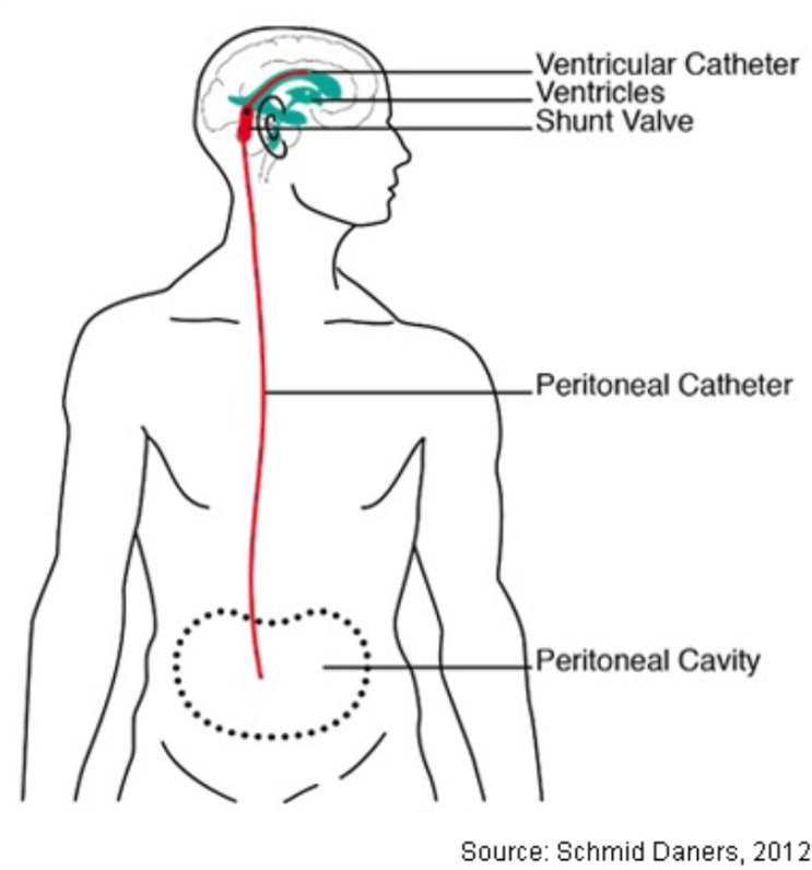 V-P shunt (ventriculoperitoneal shunt) 뇌실복강 간 단락술 codman certas valve ...