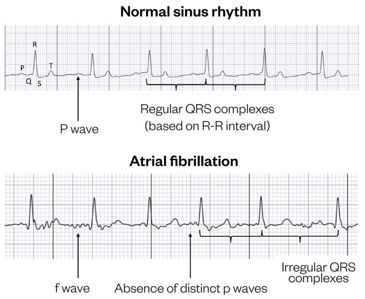 의학용어 A-fib(Atrial Fibrillation) 약물요법과(Bisoprolol, Amiodarone, NOAC ...