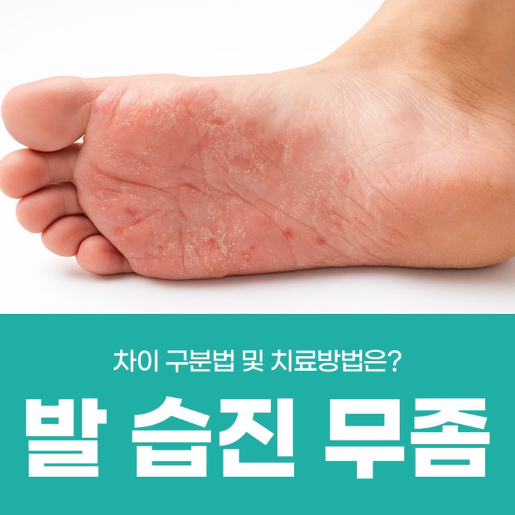 발 습진 무좀 차이 구분법 및 치료방법은? : 네이버 블로그