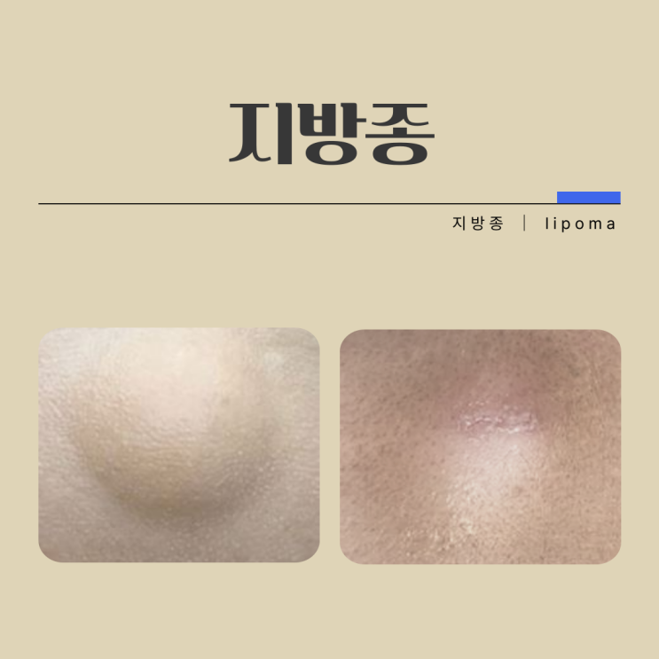 옆구리 종기 지방종 계속 자란다면 : 네이버 블로그