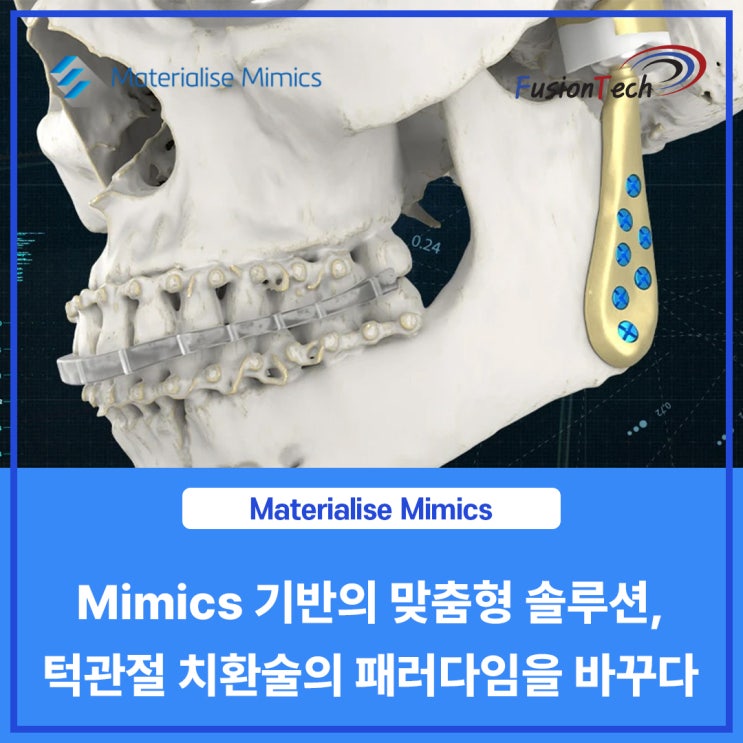 [Materialise S/W] Mimics 기반의 맞춤형 솔루션, 턱관절 치환술의 패러다임을 바꾸다 : 네이버 블로그