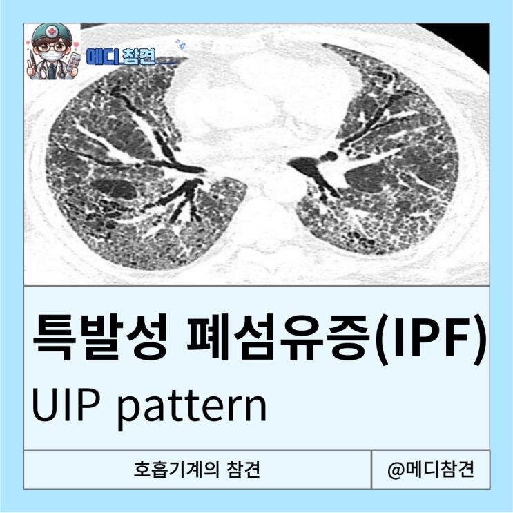 IPF 의학용어 UIP pattern idiopathic pulmonary fibrosis : 네이버 블로그