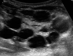 Case Study_891: [신생아·소아 신장질환] 다낭성 이형성 신장(Multicystic Dysplastic Kidney ...