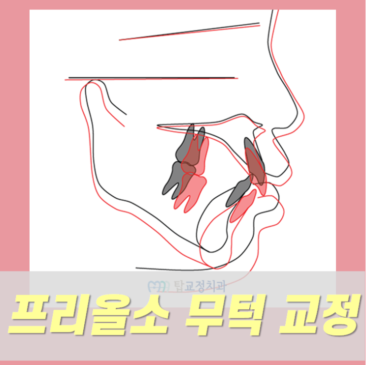 프리올소 무턱 교정, 과개교합 개선 및 아래턱 성장 : 네이버 블로그