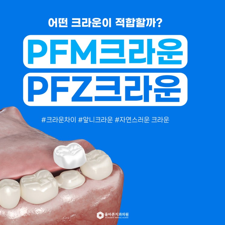 PFZ 크라운과 PFM 크라운의 차이점 구로동치과가 알려줄게요 : 네이버 블로그