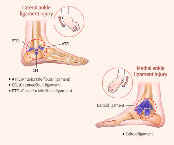 Ankle Ligament Injury (Ankle Sprain) and Adipose-Derived Stem Cells ...