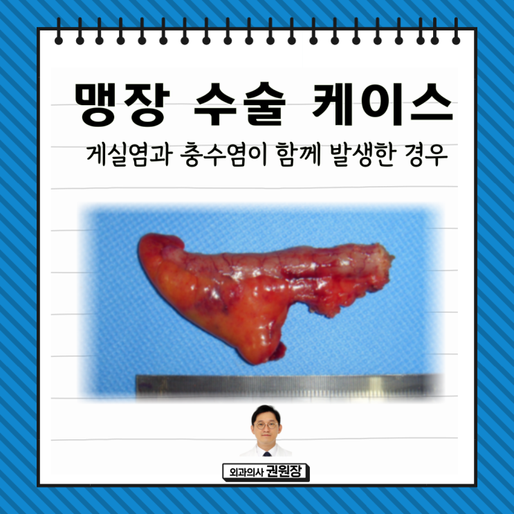 게실염과 충수염 (맹장염) 동시에 발생한 경우, 복강경 맹장 수술 : 네이버 블로그