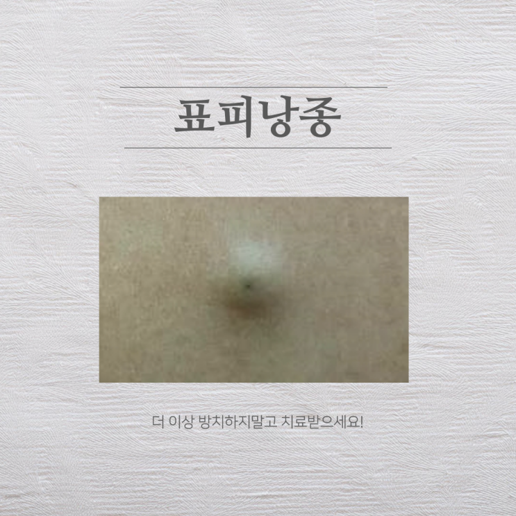 배 표피낭종 원인, 증상, 치료 방법 : 네이버 블로그