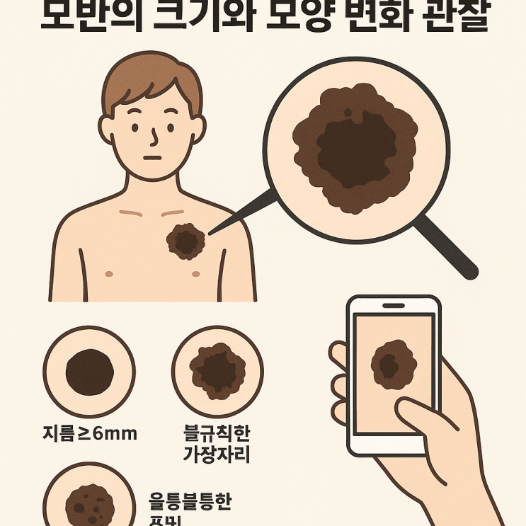 [부산양성모반]모반 제거 수술, 꼭 받아야 할까? 판단 기준 5가지 : 네이버 블로그