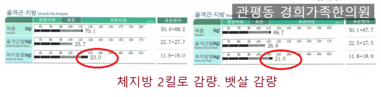 [관평동 다이어트 한약] 운동해도 안빠지는 뱃살, 드디어 빠지고 있어요 - 50대 한약 다이어트