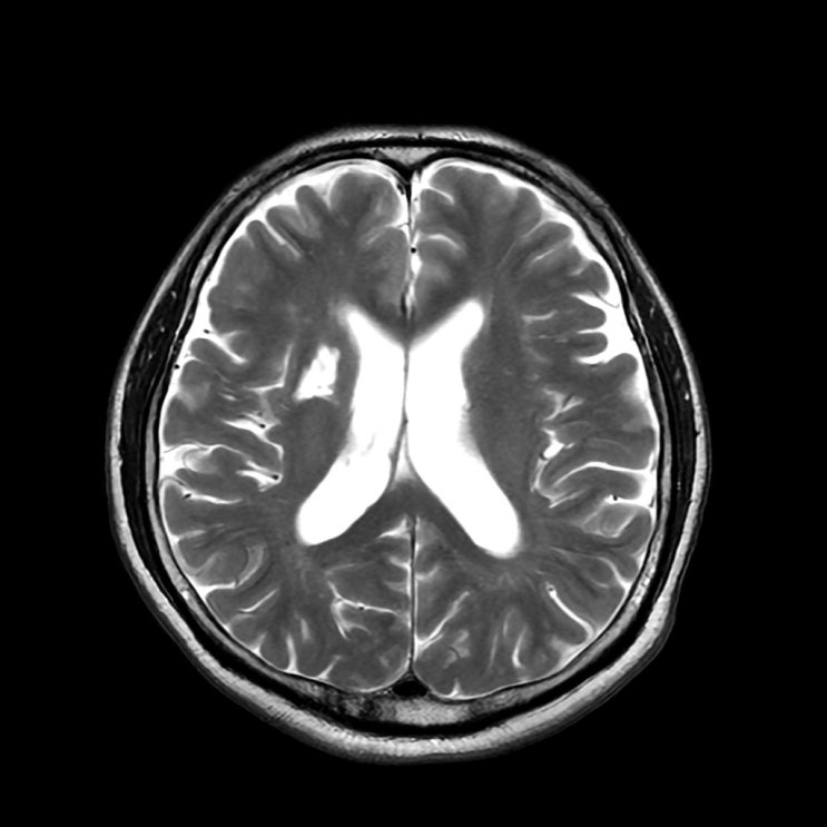 old infarct on T2-weighted MRI : 네이버 블로그