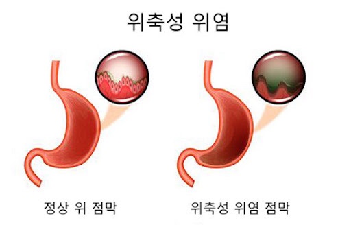 위염 증상 및 역류성 식도염 증상, 정확한 구별과 대처법 : 네이버 블로그