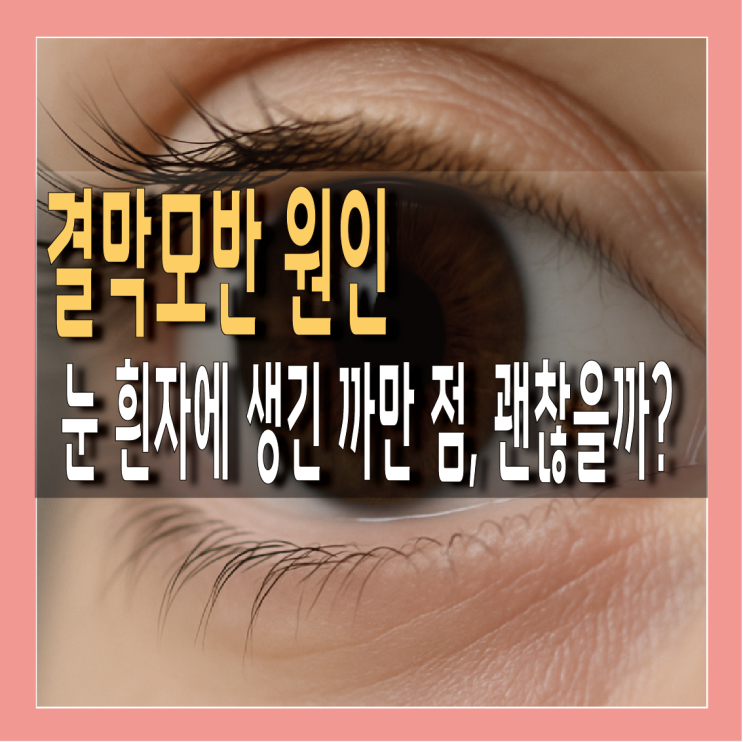 결막모반 원인과 제거 방법 A to Z : 네이버 블로그