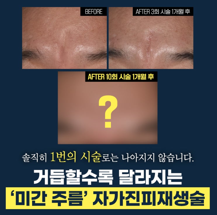 깊은미간주름제거 찌푸리는 습관이 만든 주름 개선하려면 : 네이버 블로그