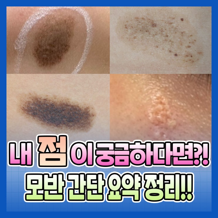 점?! 모반?! 내 점이 궁금하다면!! 모반 간단 요약 정리 : 네이버 블로그