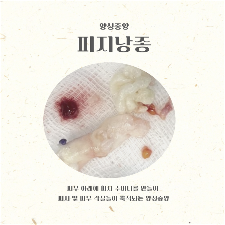 귀 뒤 혹 피지낭종 재발위험 낮추려면 : 네이버 블로그