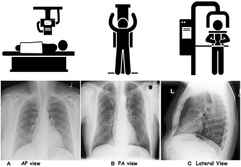 134) Chest X-ray ①: Chest PA(Posteroanterior), Chest AP(Anteroposterior ...