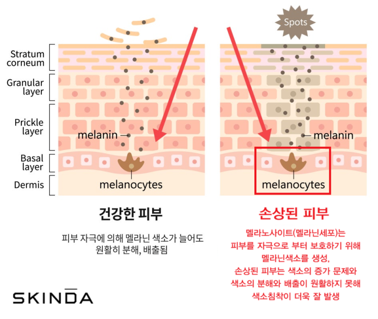 입주변 착색, 염증 후 색소침착(PIH) 원인 및 치료 방법 : 네이버 블로그