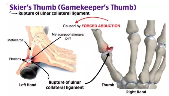 손과 관련된 질환들 (Jersey finger, Boxer's Fx, Gamekeeper's Thumb) : 네이버 블로그