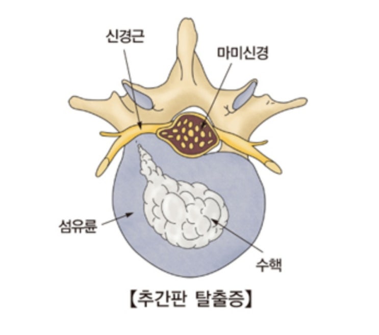 추간판이 돌출되어 요통 및 신경 증상을 유발하는(요추 추간판 탈출증=허리디스크) : 네이버 블로그