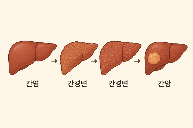 간염에서 간암으로 발전하는 과정 : 네이버 블로그