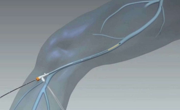GSV) (노) Varicose veins RFA (Both) : 네이버 블로그