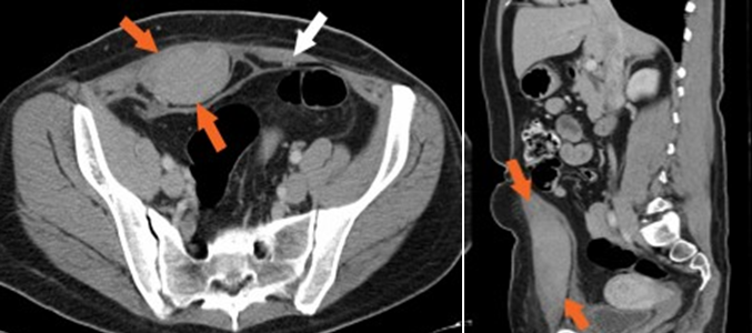 Case Study_931:복직근초 혈종 (Rectus Sheath Haematoma) – CT로 진단된 증례 : 네이버 블로그