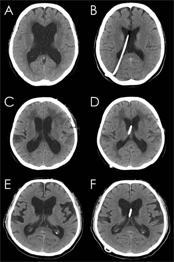 143) Ventriculoperitoneal(VP) shunt, EVD(External Venticular Drainage ...