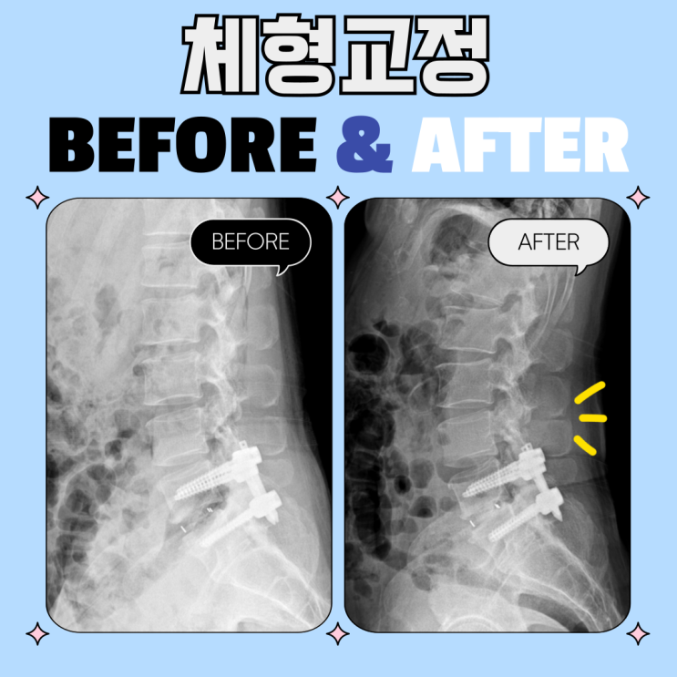 요추 유합술 후에도 허리통증? 체형교정으로 다시 살아난 요추 회복 사례! : 네이버 블로그