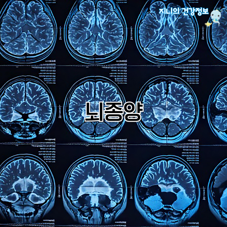 뇌종양 유전 원인, 악성뇌종양 양성뇌종양 : 네이버 블로그