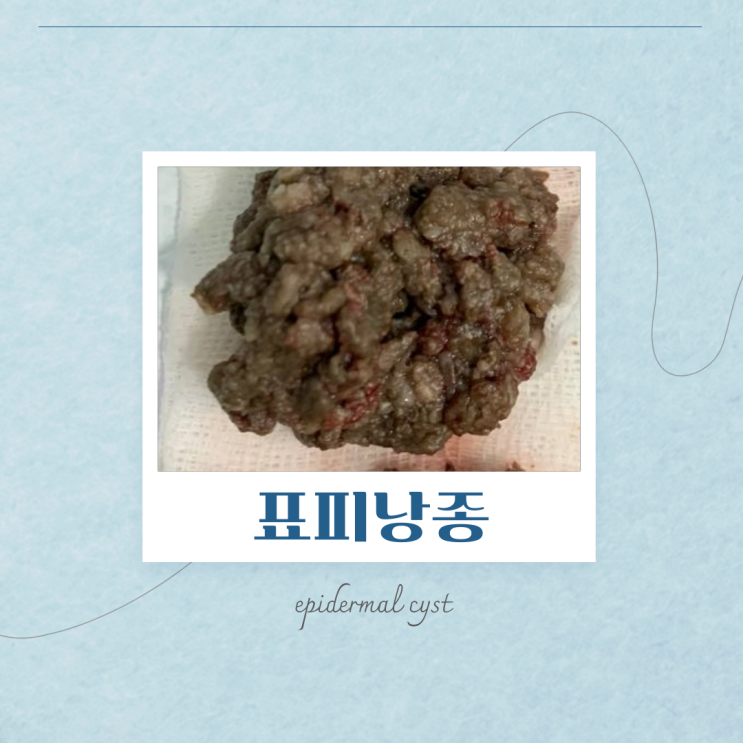 팔 멍울 통증 표피낭종때문이라면 : 네이버 블로그