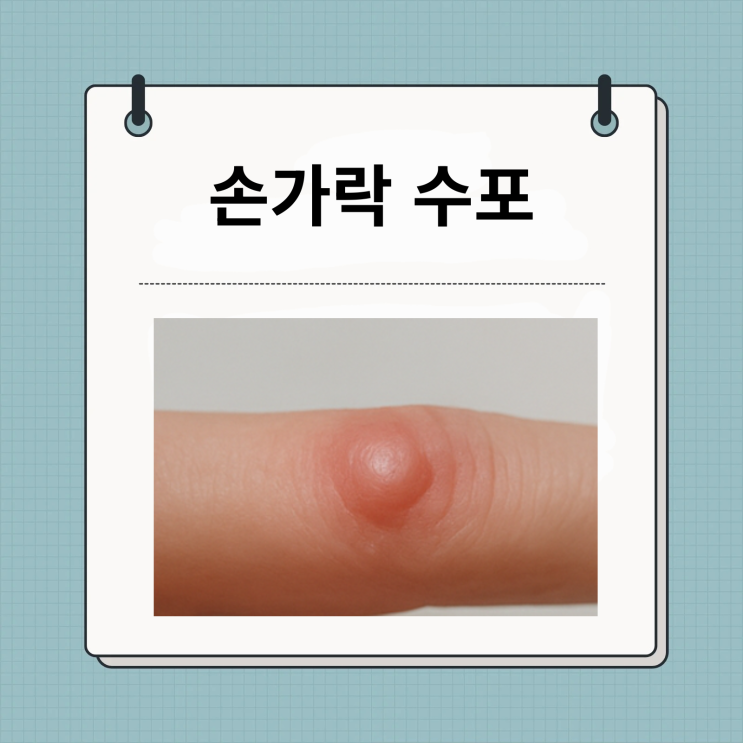 손가락 수포 원인부터 치료·예방까지 한 번에 알아보기 : 네이버 블로그