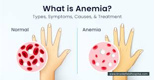 🩸Chapter1. 빈혈(Anemia)의 원인, 증상, 치료 – 제대로 알아보기 : 네이버 블로그