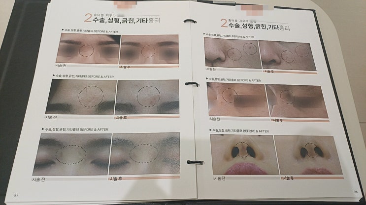 대구동성로한의원│패인 흉터 새살침 1회 받고난 후기 : 네이버 블로그