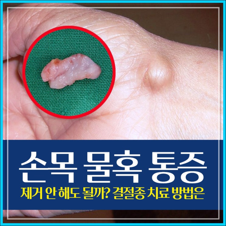 손목 물혹 통증 없으면 제거 안 해도 될까? 결절종 치료 방법은 : 네이버 블로그