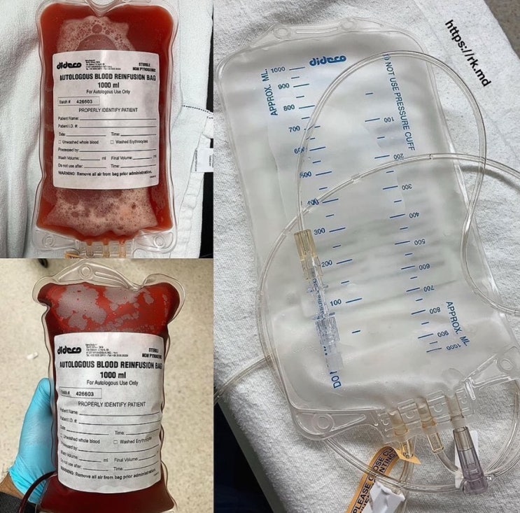 Cell saver, Cell salvage : 네이버 블로그