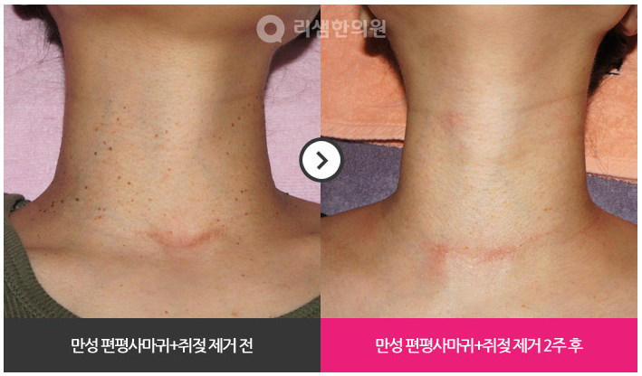 편평사마귀 · 쥐젖 제거, 흉터 없이 안전하게 : 네이버 블로그