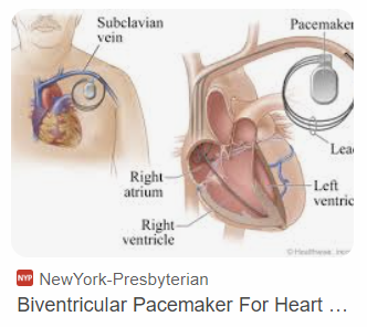 [USMLE review] biventricular pacemaker for CHF, 만성심부전에서 양심실성 심박조율기 ...