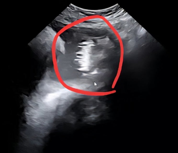 임신기록)임신 후기 31주~ 34주 증상 | 왼쪽아랫배통증, 질염, 관절통, 붓기, 쥐젓, 방광염, 배뭉침, 왼쪽허리통증, 수면 ...