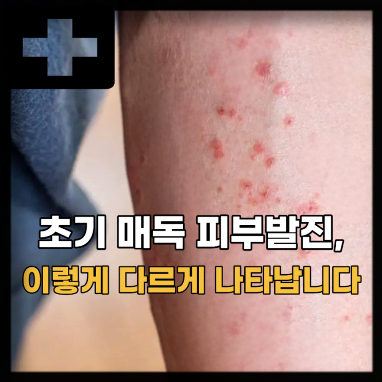 매독 초기 증상 검사, 여자 남자 매독 증상은? : 네이버 블로그