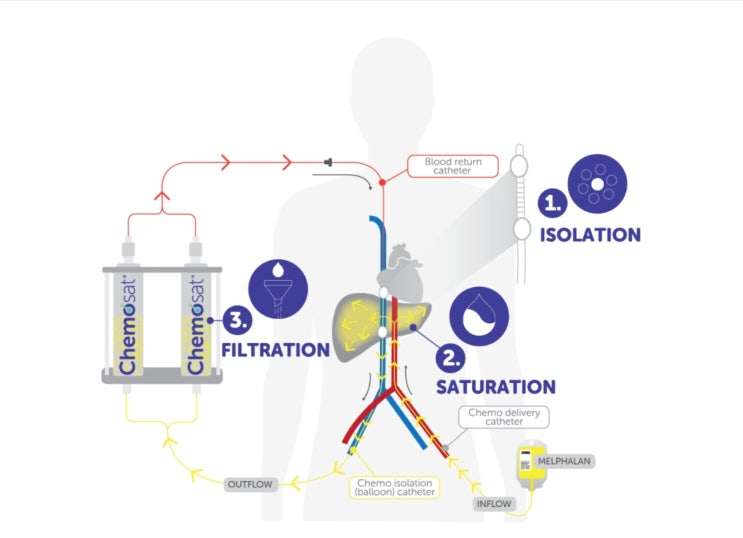 Delcath systems Inc(NASDAQ: DCTH) : 네이버 블로그