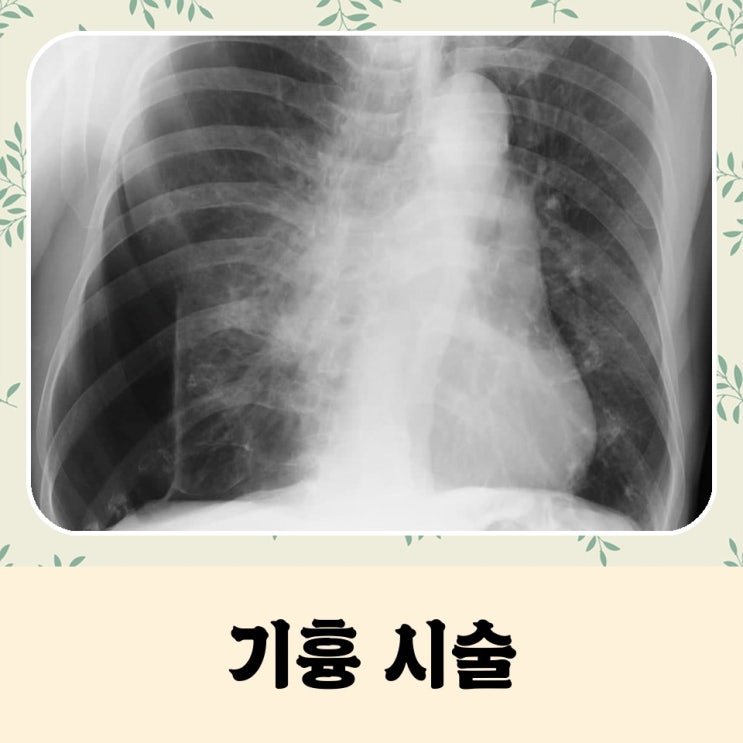 기흉 시술 언제 어떻게 진행될까요? : 네이버 블로그