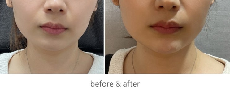 부천 피부과 턱필러, 자갈턱 보톡스 후기 : 네이버 블로그