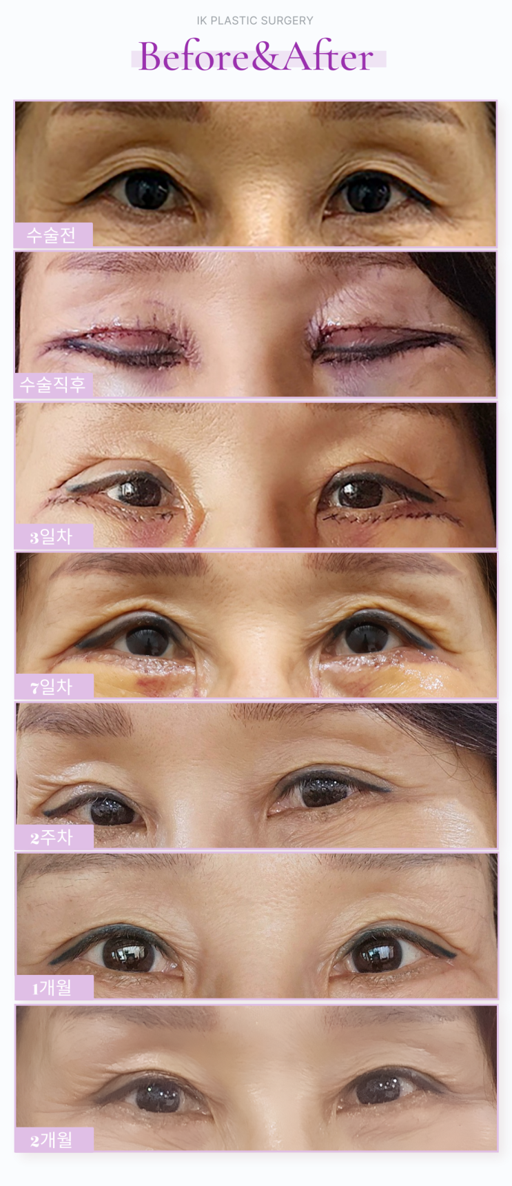 상안검 하안검 가격과 수술 결과 2개월차 리얼 후기 : 네이버 블로그
