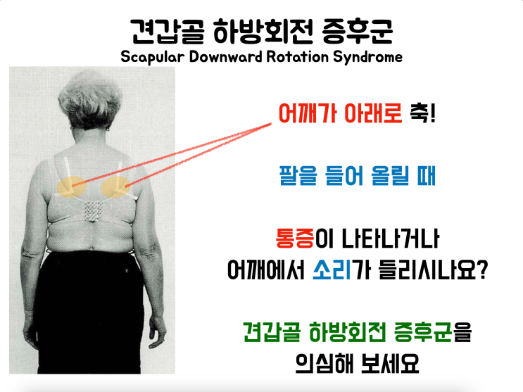 견갑골 하방회전 증후군(Scapular Downward Rotation Syndrome) : 네이버 블로그