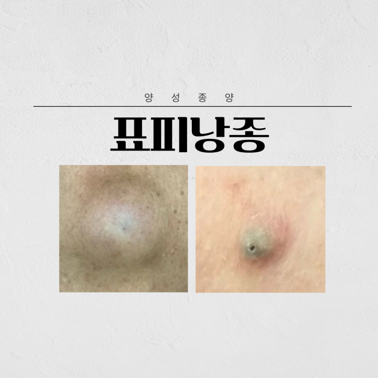 표피낭종 외과 내원 전 확인하고 가세요! : 네이버 블로그